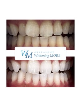 ホワイトニング モア(Whitening MORE)/ビフォーアフター