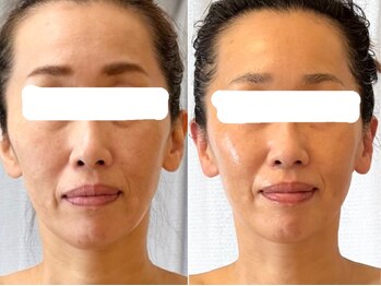 グラースア(grace a)/立体感のある小顔へ