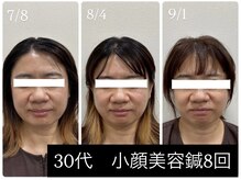 ラムーン(La.Moon)/小顔・美容鍼８回