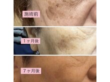 光フォト・シミbefore・After