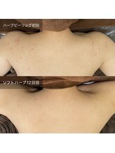 ビビ(VIVI)/背中のかゆみにも◎