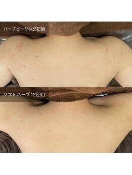 ビビ(VIVI)/背中のかゆみにも◎