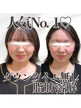 ミタメ 銀座店(MITAME)/お顔の脂肪を落としたい方に!