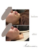 ハリムーン 仙台(harimoon)/美容鍼灸ビフォーアフター