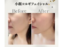 ラフォクシー(La.Foxy)の雰囲気（リフトアップすることで、ほうれい線もフェイスラインもスッキリ）