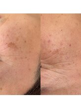 ギャラクシービューティー(galaxy beauty)/プラズマシミケア