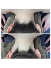 ミース 北九州店/うなじ◇ビフォーアフター