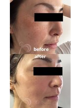 セレネ(SELENE)/肌のくすみ、シミ