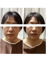 さっぽろ心灯はり きゅう院/ハリスリム 札幌山鼻(Hari-Slim)/小顔・肌質↑美容鍼