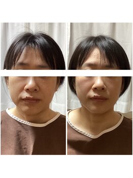 さっぽろ心灯はり・きゅう院/小顔・肌質↑美容鍼