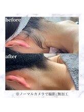 エルアンドエル(L&L)/うなじスッキリ！