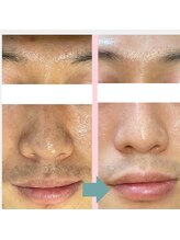 レベンディス(LEVENDIS)/ハーブピーリング×毛穴洗浄