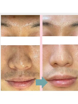 レベンディス(LEVENDIS)/ハーブピーリング×毛穴洗浄