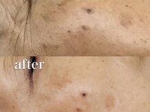 エイプリル/【ハーブピーリング】比較写真