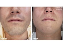 ラッシュ(RUSH)/3ヵ月＋メンテナンスで完了！