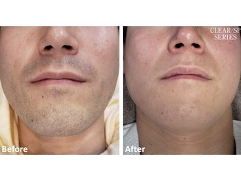 ラッシュ(RUSH)/3ヵ月+メンテナンスで完了!