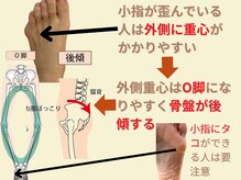 ニコ(niko)/小指パターンはO脚になります