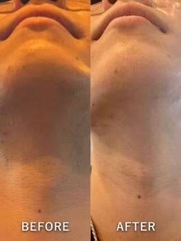 ビークリア(B.clear)/メンズ・ヒゲ脱毛