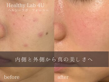 ヘルスラボフォーユー(Health Labo4U)/赤ニキビにも!