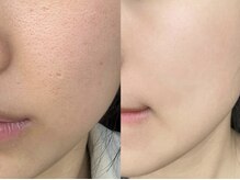 プラチナスタイル(platinum.style)/水素水毛穴洗浄 before after