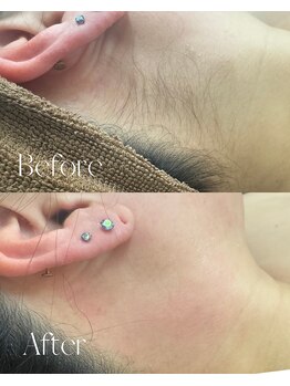 マテオ(Matteo)/うなじワックス＋SHR脱毛