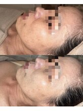 ベルチャーム(Bellecharm)/くすみやごわつきお肌のハリUP◎