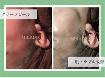 ミカド(MIKADO)/皮膚の赤みにハーブピーリング