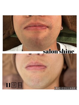 サロンシャイン(Salon Shine)/メンズヒゲ脱毛