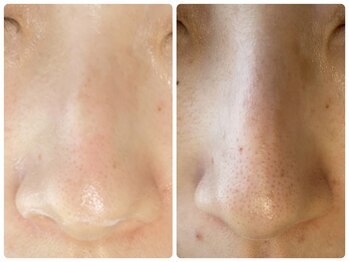 ラヴィ(Ravi)/開いた鼻、毛穴ケア