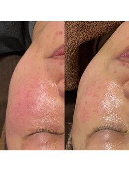 ミヨン(Miyong)/続けることでお肌は変わります!