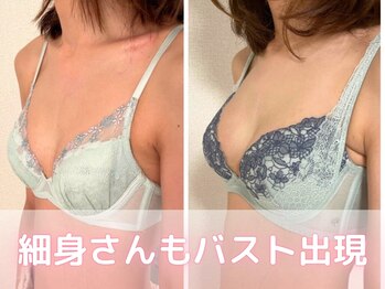 ヒヨコ 池袋西口店(Hiyoko)/バストアップ症例/育乳