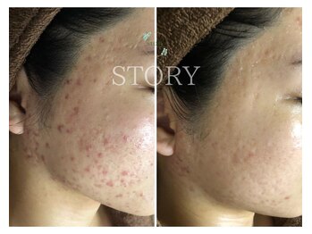 ストーリー(STORY)/ハーブピーリング専門店STORY