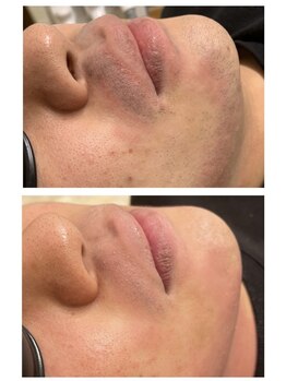 レヴール(reveur)/メンズヒゲ脱毛[脱毛/ひげ脱毛]