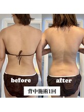 メトルミリ 新宿店(Metre milli)/お背中施術