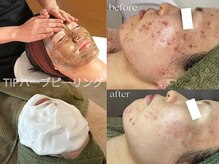 ココホワイトニング(coco whitening)