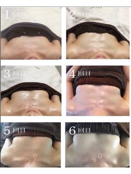 美人バスト 本厚木店/バストアップ◇症例◇