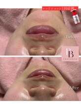 フォトビズ/たるみもたつきゼロ！憧れの小顔