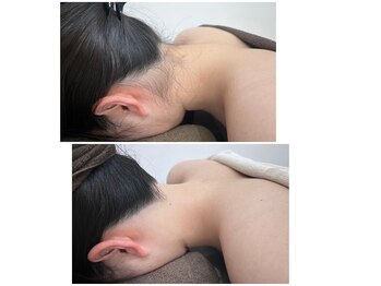 ミース 川崎店/うなじ矯正◆ビフォーアフター