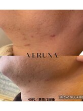 アトワ(A toi)/ハーブピーリング（棘あり）