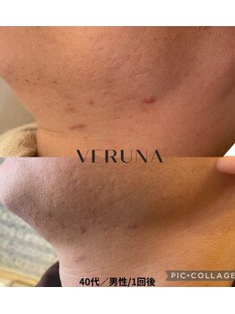 アトワ(A toi)/ハーブピーリング(棘あり)