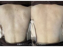 美肌ケアサロンiru 三ノ宮店【ハーブピーリング | ララピール | 毛穴洗浄】の雰囲気(背中のハーブピーリング)