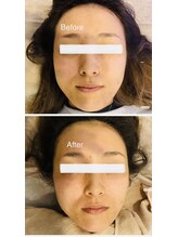 セラス(CERAS)/フォースカッター　フェイシャル