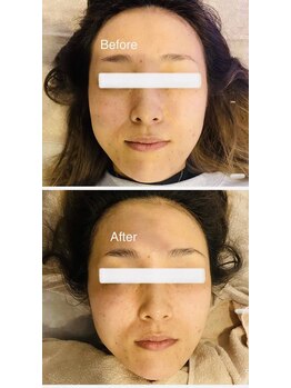 セラス(CERAS)/フォースカッター　フェイシャル