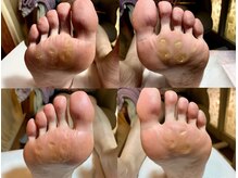 ビサンテ サロン/酷い足裏の角質＆自爪ケアに人気