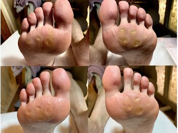 ビサンテ サロン/酷い足裏の角質&自爪ケアに人気