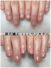 スマイルニコ(smile nico)/就活前に深爪を改善