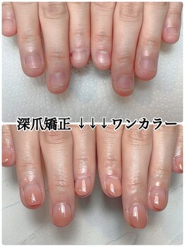スマイルニコ(smile nico)/就活前に深爪を改善