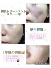 サロンデュヒャーク 志木駅前店(salon du ひゃーく)/陶肌&ホームケアで肌質改善！