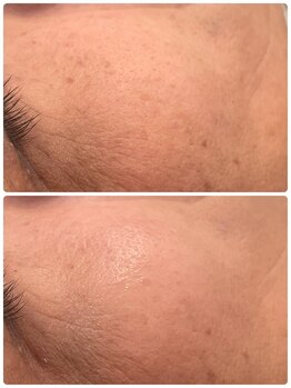 トリアングル(TLIENGLE)/ハーブピーリングbefore after