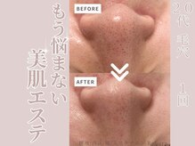 リボーン(Reborn)/20代　毛穴(1回)